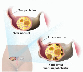 sindromul ovarelor polichistice