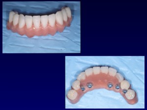 implantologie si estetica dentara