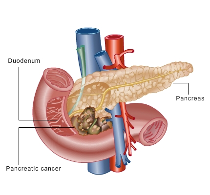 Cancerul pancreatic 2014