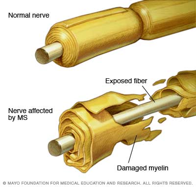 Pacinetii cu scleroza multipla: cum este afectat nervul de scleroza multipla