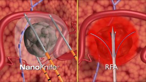 NanoKnife, cancerul cefalopancreatic