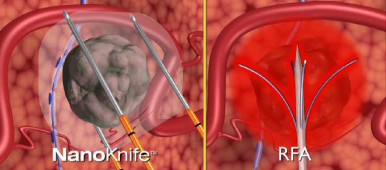 NanoKnife, cancerul cefalopancreatic