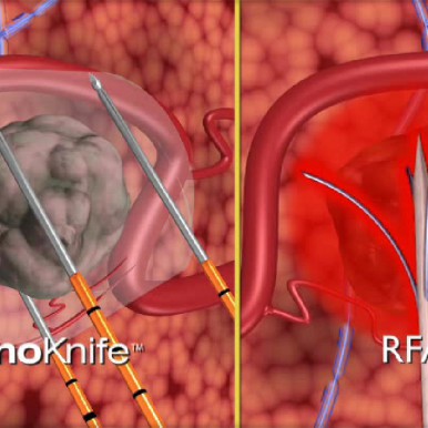 NanoKnife, cancerul cefalopancreatic