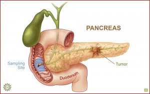 Cancer cefalopancreatic