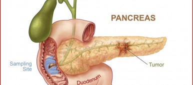 Cancer cefalopancreatic