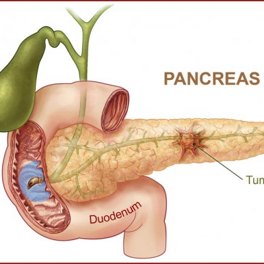 Cancer cefalopancreatic