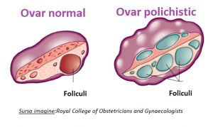 sindromul ovarelor polichistice