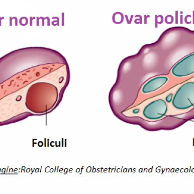 sindromul ovarelor polichistice