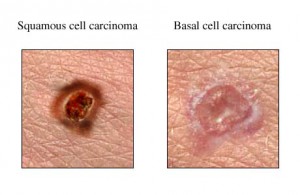 cum sa previi cancerul de piele