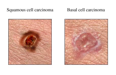 cum sa previi cancerul de piele