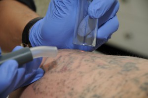 Laser eraser stergere tatuaje