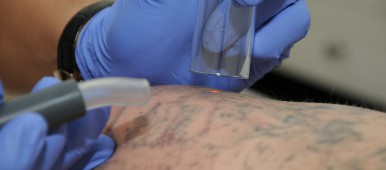 Laser eraser stergere tatuaje