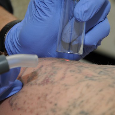 Laser eraser stergere tatuaje