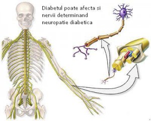 Neuropatia diabetica