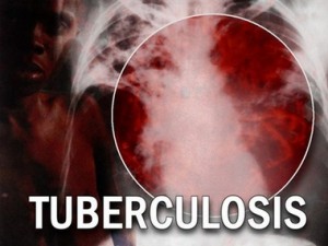infectie cu tuberculoza