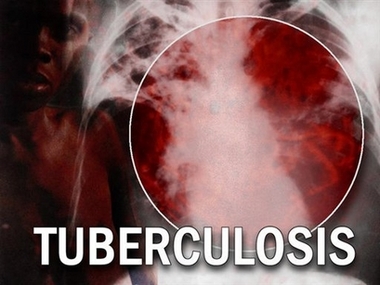 bedaquilina, medicament impotriva infectiei cu tuberculoza