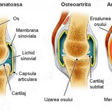 Poliartrita reumatoida