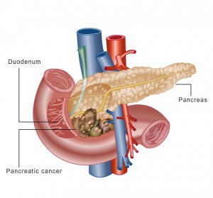 Cancer pancreatic 2014