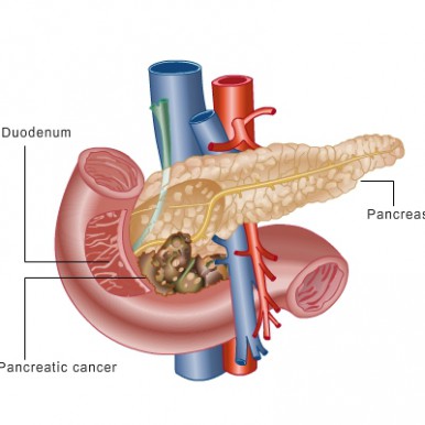 Cancer pancreatic 2014