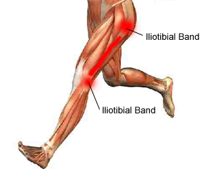 Remedii pentru durerile de genunchi; Sindromul tendonului iliotibial