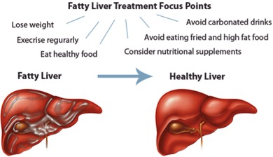 Ficatul gras la copii sau steatoza hepatica nonalcoolica