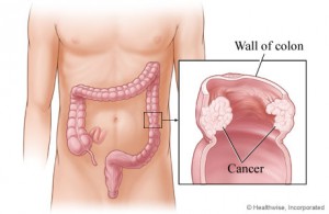 cancer colorectal 