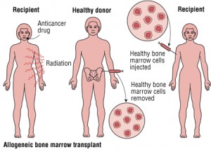 transplant de maduva